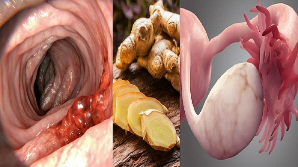 Ginger prevents ovarian and colon cancer